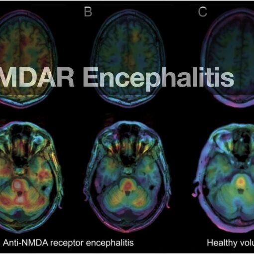 A brain scan of Anti-NMDAR Encephalitis